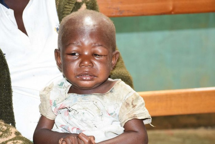 enfantmalnutri-but-f4e